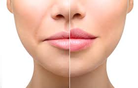 Advanced Lip masterclass online aesthetics course. Course includes Facial Anatomy, Lip Anatomy, Elective Hyalase, Emergency Hyalase, Signs of Infection and more.